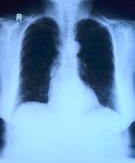 x-ray image, roentgen, thorax, lung x-ray, medicine, roentgen, roentgen, roentgen, roentgen, roentgen